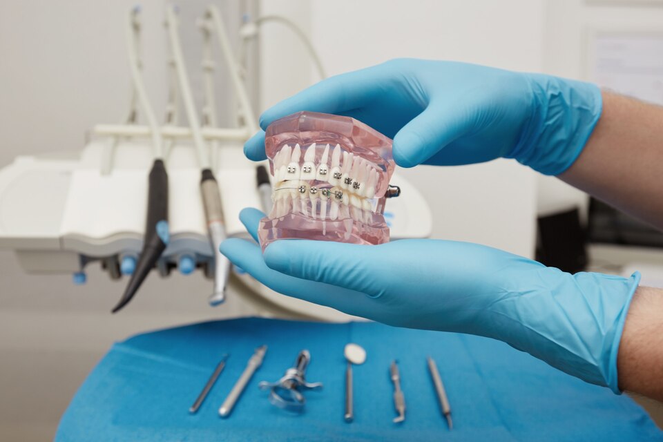 Types of Braces