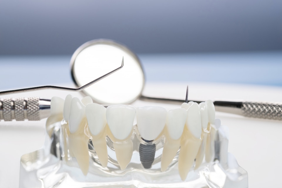 Dental Crowns