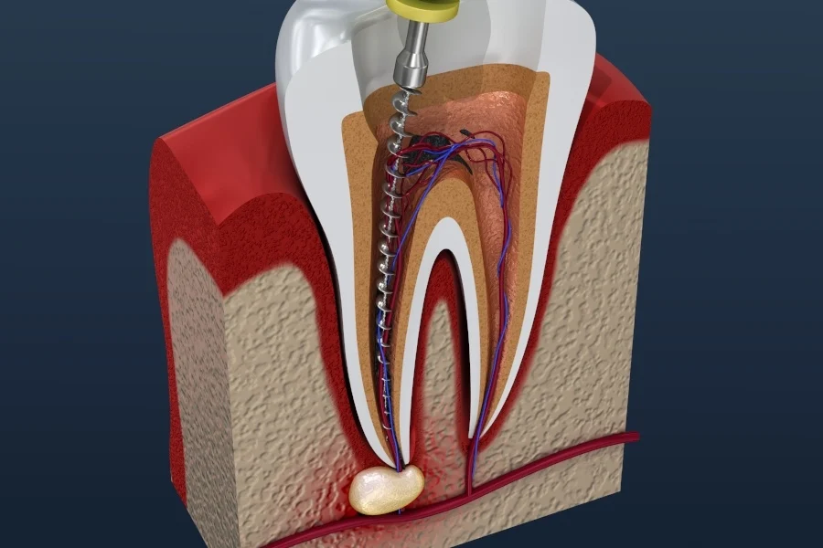 root canal therapy
