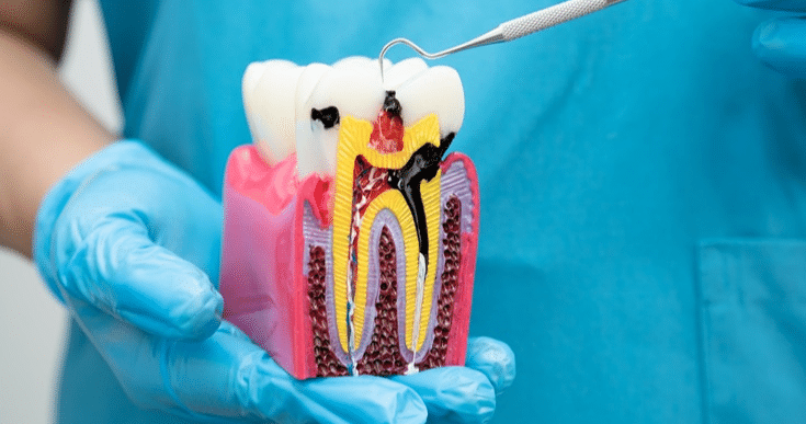 Root Canal Therapy in Kenya